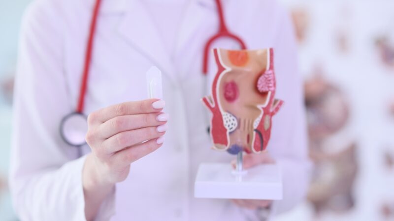 Lekar drži anatomski model analnog kanala i objašnjava razliku između hemoroida